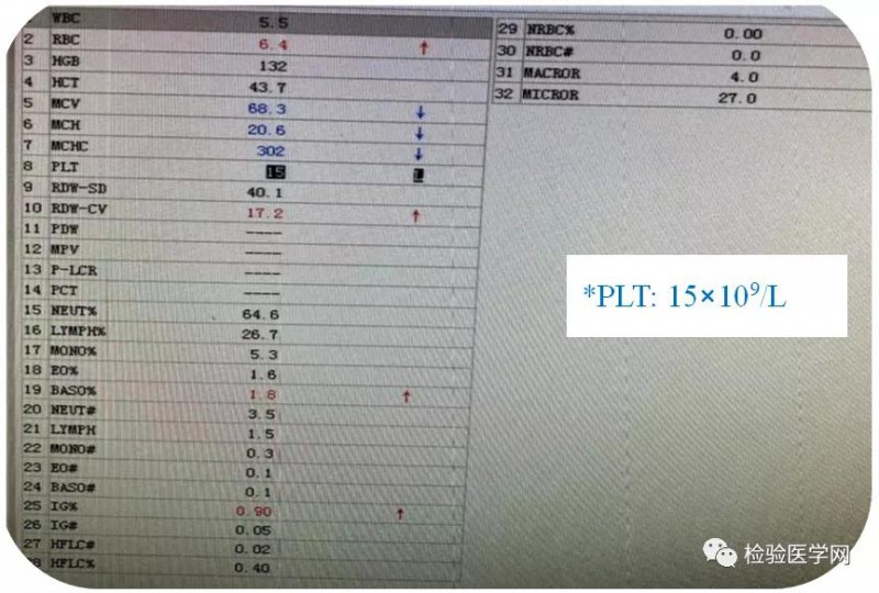 该如何侦破？容易忽视的EDTA依赖性假性血小板减少