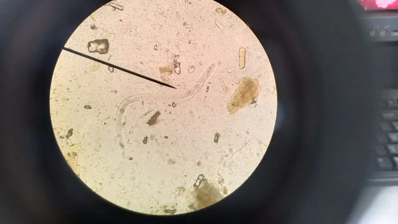 检验人请注意，显微镜下遇到这种寄生虫，可要擦亮眼睛！