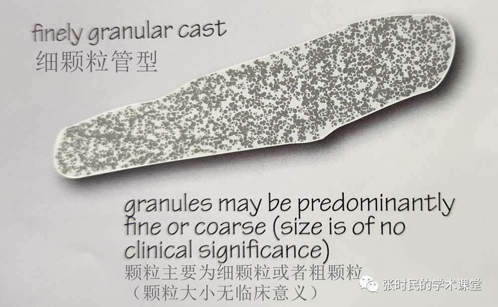 【张时民教授解读专家共识】之管型篇——2.颗粒管型