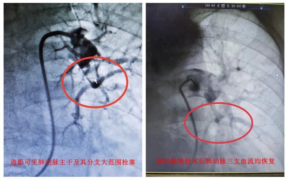 阳后一个月，肺栓塞风险升高33倍！如何预防？