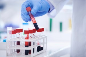 高效液相色谱法与液相色谱-串联质谱法检测人血清中脂溶性维生素的一致性评价