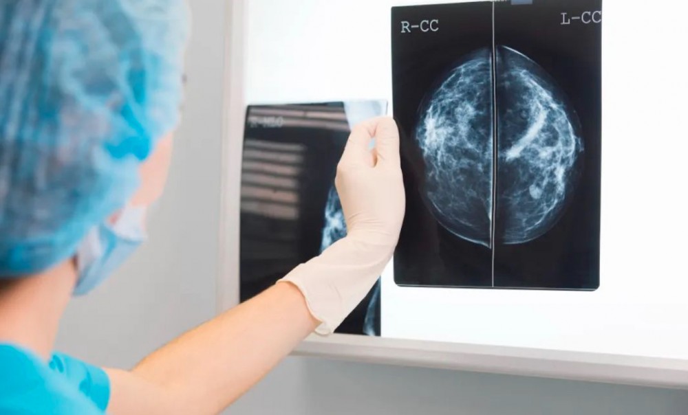 关明教授：同源重组修复缺陷在乳腺癌发生风险和治疗中的临床价值