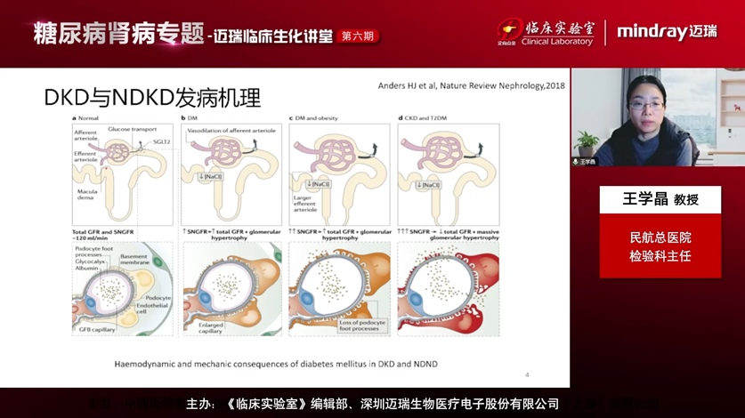 王学晶—糖尿病肾病实验室诊断新进展