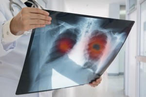 miRNA检测在恶性肿瘤和传染病诊断中的临床价值与检测方法