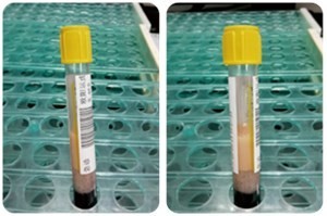 急诊检验严重脂血样本检测干扰机制与处理方法