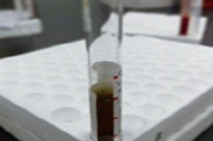 罕见绿色血清一例临床诊疗分析