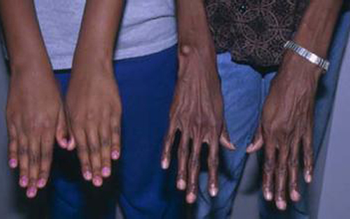 面对遗传性疾病时：中美两个家庭的不同经历