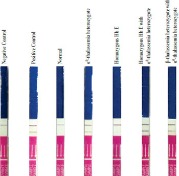 用免疫层析试纸筛查α-地中海贫血症