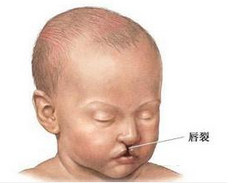 先天性兔唇遗传基因新关联位点发现
