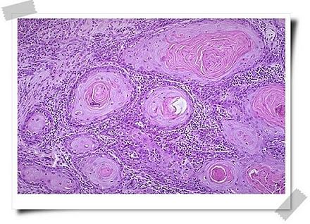 专家呼吁降低女性宫颈癌筛查频率