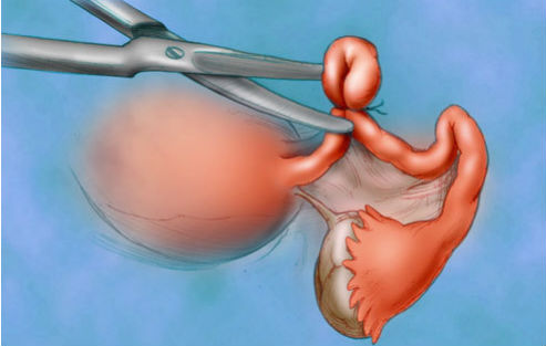 PNAS：mRNA诊断早期卵巢癌成为可能