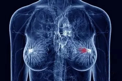 大规模测序发现乳腺癌和卵巢癌的易感基因