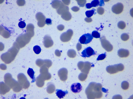 【检验临床面对面】淋巴浆细胞淋巴瘤/华氏巨球蛋白血症1例