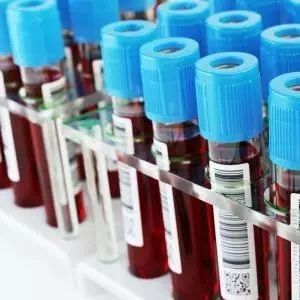 凝血检查在DIC诊断系统中有多重要？