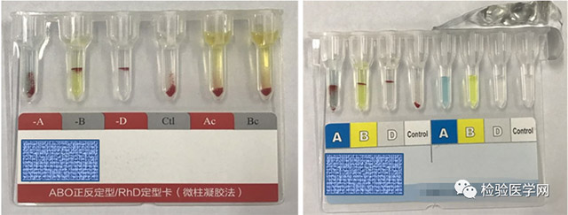 溶血！正反定型不一致，究竟该如何确定血型？