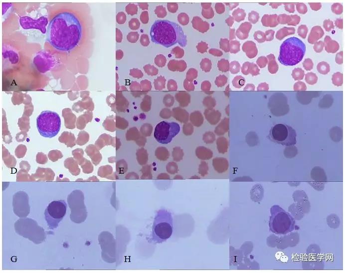 异型淋巴细胞？浆细胞？你有没有鉴别错过