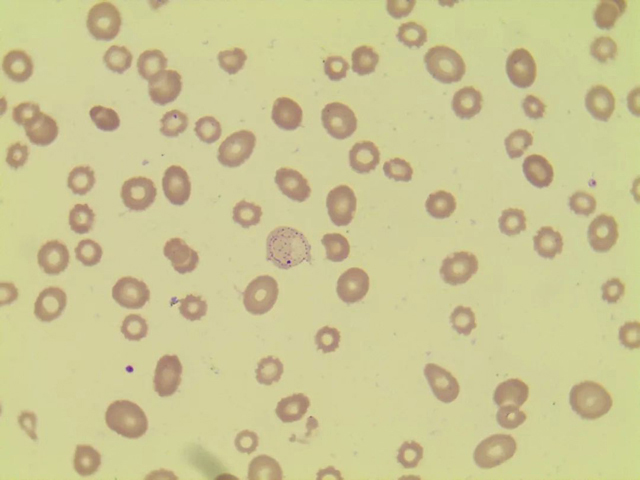 MDS or MA——我有特别的鉴别技巧
