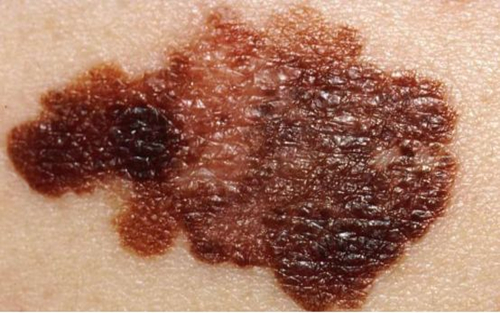 鼻咽癌标志物、环状RNA、癌症新疗法等最新前沿动态