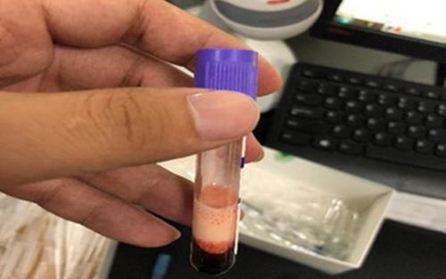 一例重度乳糜血标本，到底是谁在干扰血常规结果？