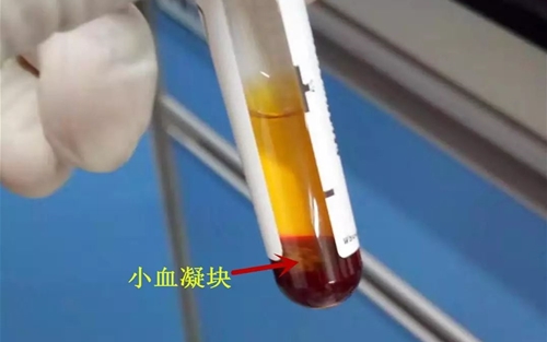 D-二聚体130.7mg/L，静脉血栓栓塞or肺栓塞?