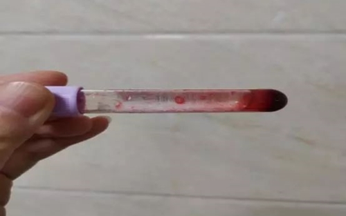 血小板计数究竟是多少？