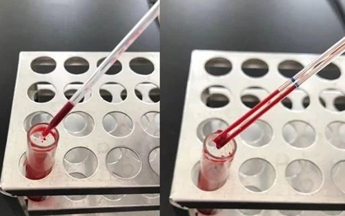 血液湿片2秒辨真假血小板减少
