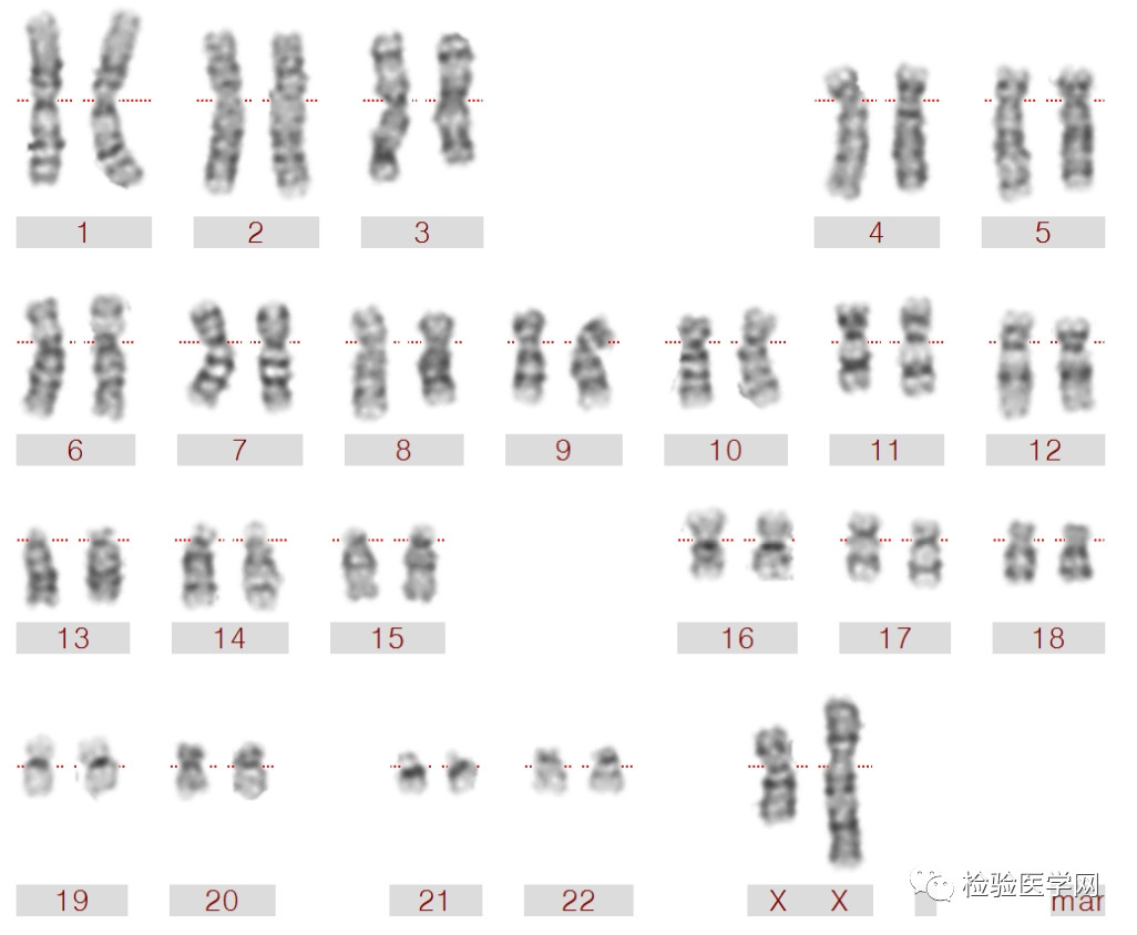 Karyogramm (Chromosomenanalyse) • Störungen erkennen